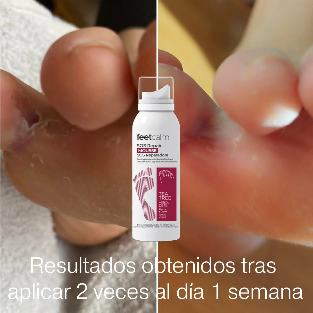 Resultados antes y despues Mousse SOS antifúngico para piel FeetCalm