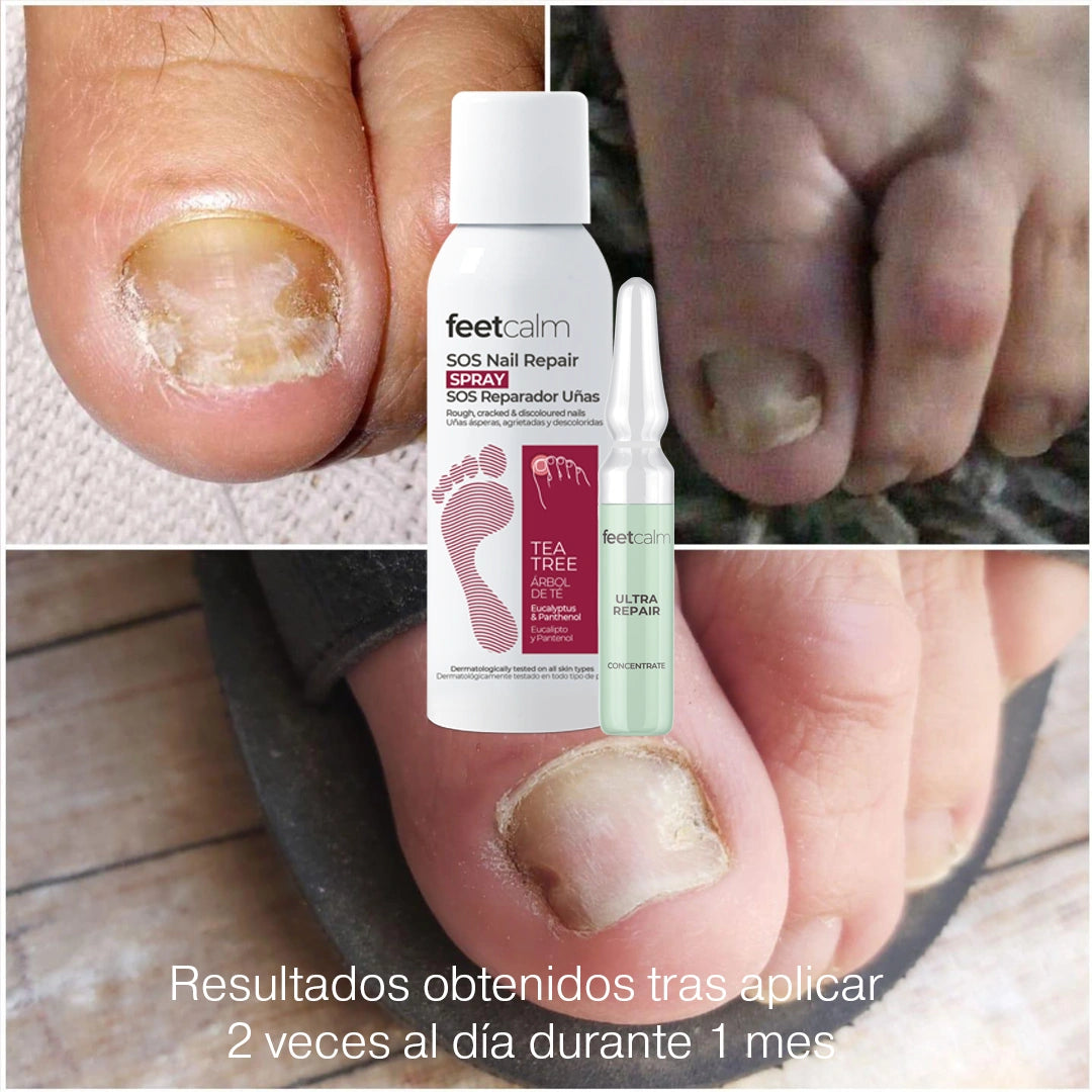 Spray SOS antifúngico para uñas