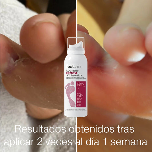 Resultados antes y despues Mousse SOS antifúngico para piel FeetCalm