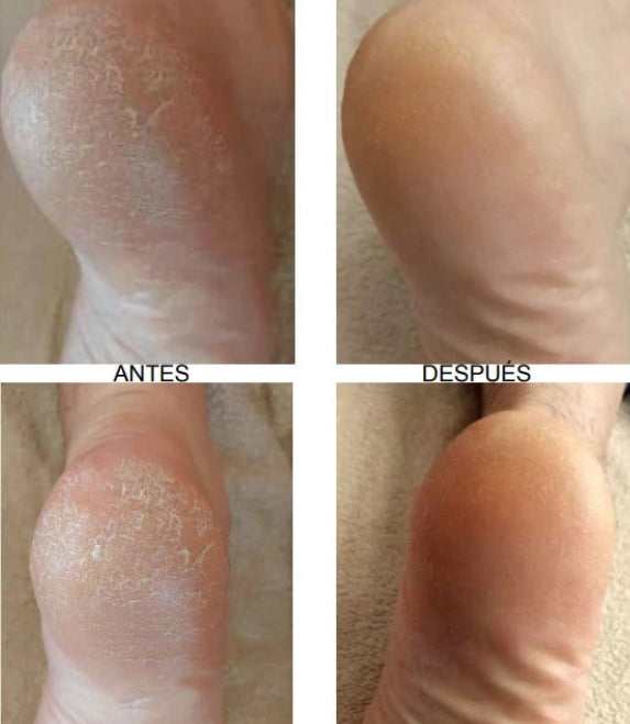 Mousse réparatrice pour talons crevassés 25 % urée