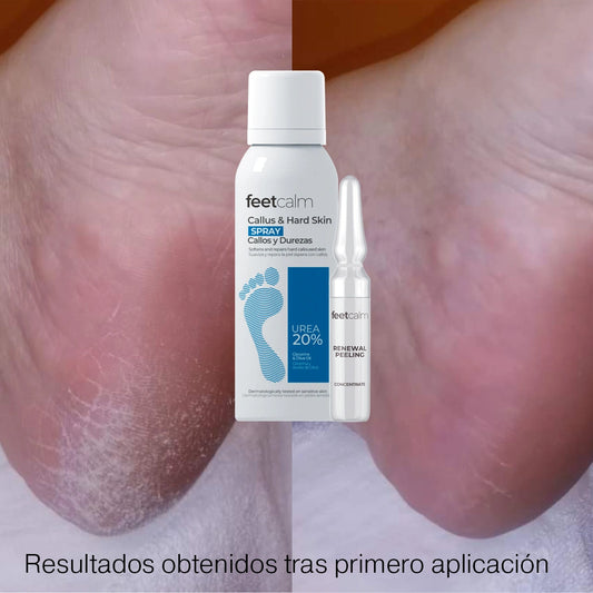 Resultados spray callos u ampolla renewal peeling feetcalm