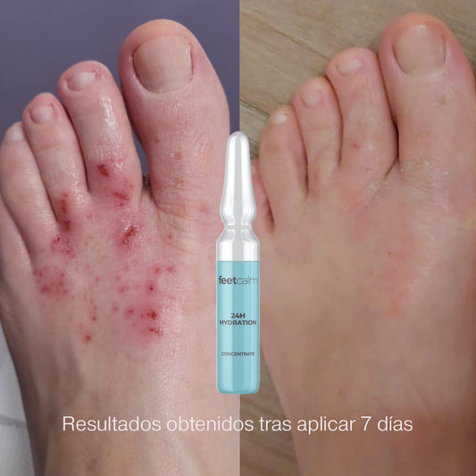 Ampollas hidratacion 24H FeetCalm antes y despues