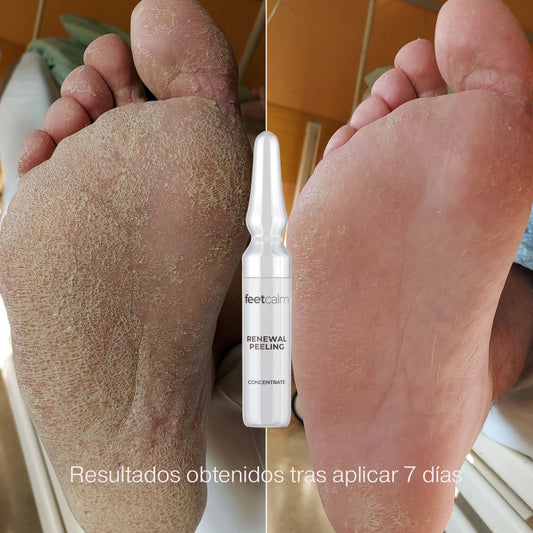 Ampolla renewal peeling concentrate con ácido glicólico antes y despues FeetCalm