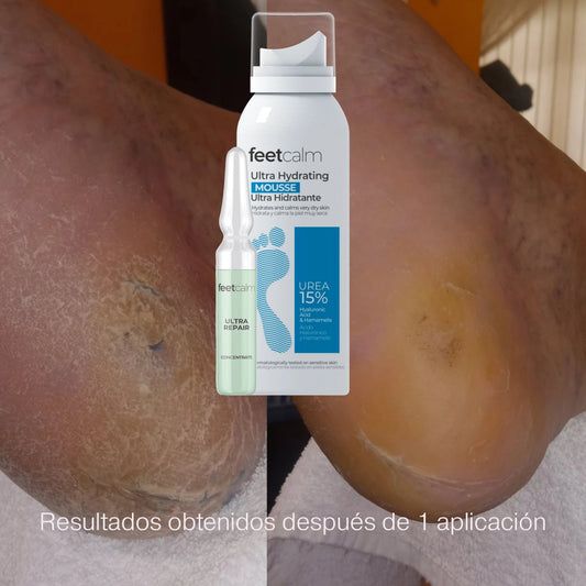 Ampolla ultra repair concentrate 30% urea y mousse ulta hidratante antes y despues FeetCalm